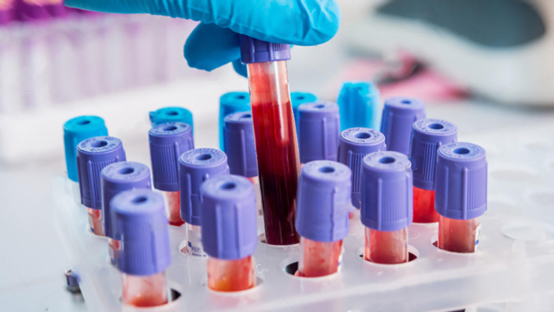 „გორმედის“ სამედიცინო ცენტრს ონკო-ჰემატოლოგიური მიმართულება დაემატა