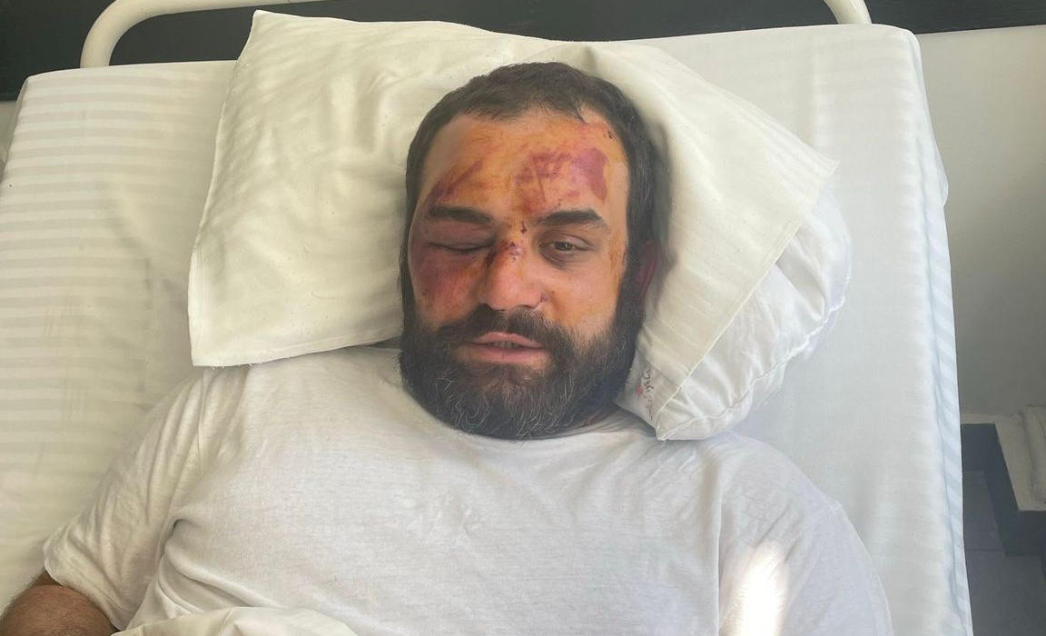 „ნაციონალური მოძრაობის“ ინფორმაციით, დიმიტრი ჩიქოვანი, რომელსაც გუშინ თავს დაესხნენ, კვლავ კლინიკაში რჩება