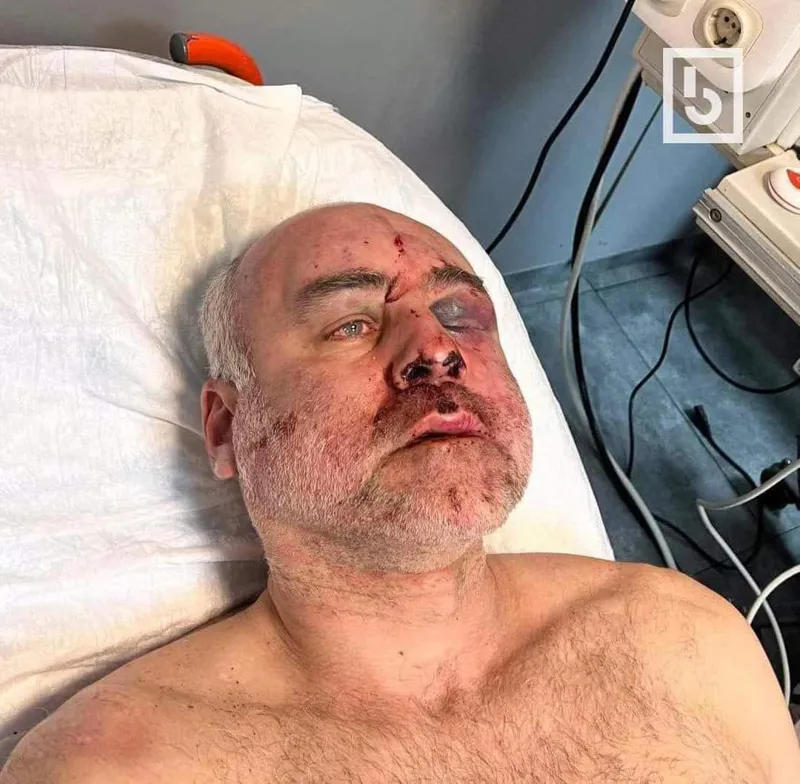 დავით ქაცარავა - თვალბუდის ძვალი მაქვს ჩამტვრეული, ასევე დამტვრეულია ზედა ყბა, ტვინის შერყევა საკმაოდ მძიმე ფორმის და სერიოზული ჰემატომები თავზე